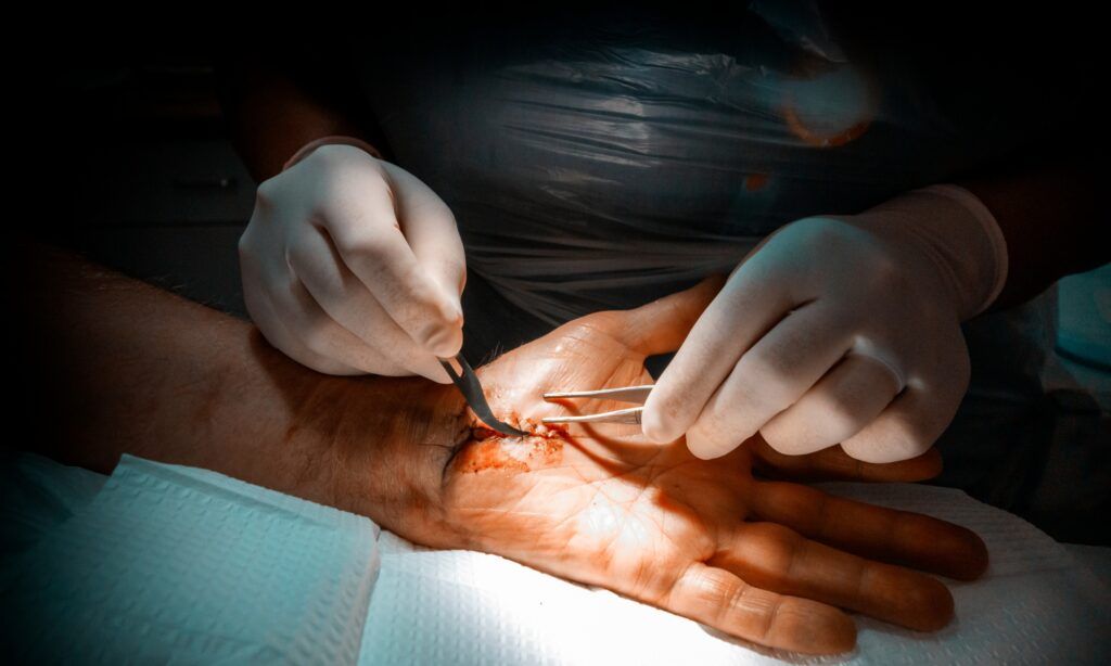CARPAL TUNNEL SYNDROME 2 Chiropractic treatment session for spinal care, highlighting professional support for patients recovering from surgery in Sydney, including Ingleburn and Kogarah Bay.