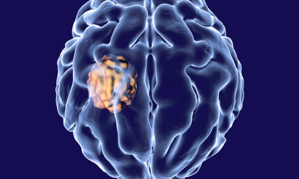 A person experiencing a neurological condition affecting their spine.